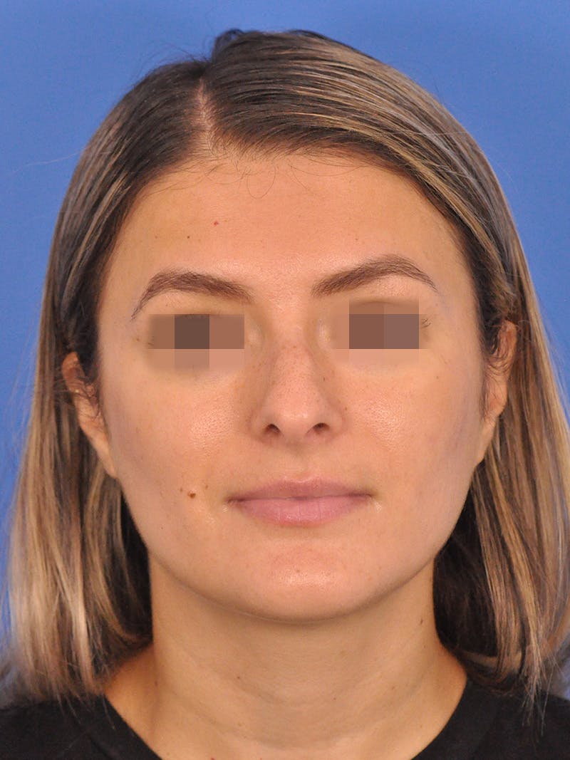 Rhinoplasty Before & After Gallery - Patient 716844 - Image 5