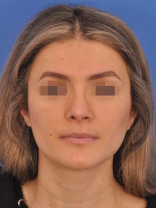 Rhinoplasty Before & After Gallery - Patient 716844 - Image 6
