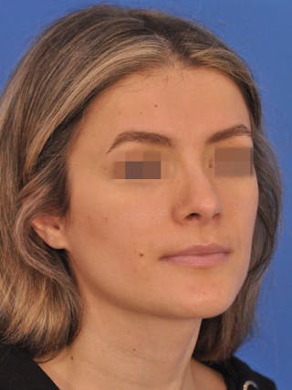 Rhinoplasty Before & After Gallery - Patient 716844 - Image 4