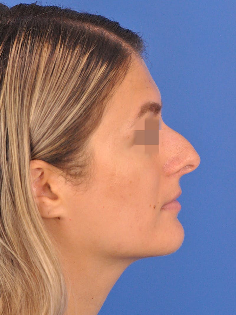 Rhinoplasty Before & After Gallery - Patient 716844 - Image 1