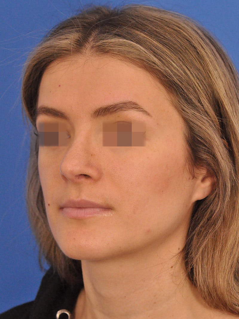 Rhinoplasty Before & After Gallery - Patient 716844 - Image 8