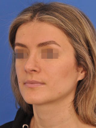 Rhinoplasty Before & After Gallery - Patient 716844 - Image 8