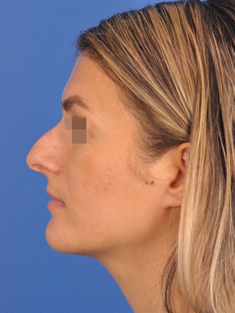 Rhinoplasty Before & After Gallery - Patient 716844 - Image 9