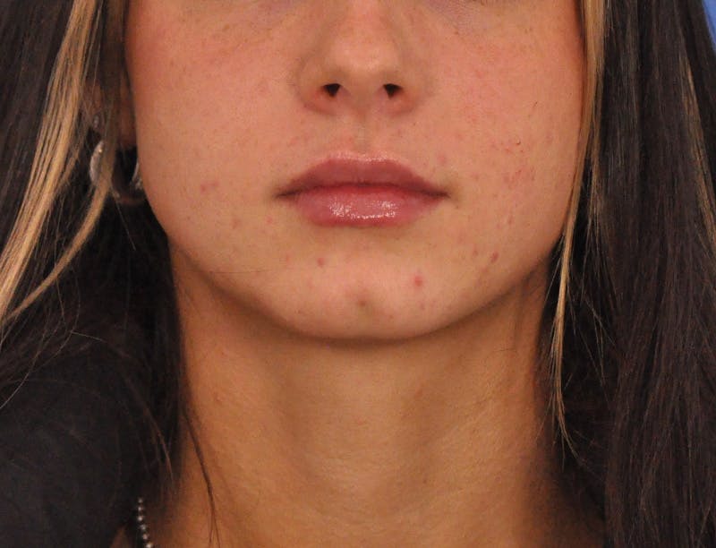 Lip Filler Before & After Gallery - Patient 829046 - Image 3