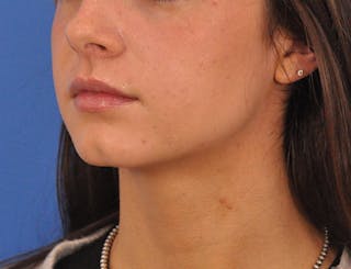 Chin Filler Before & After Gallery - Patient 525334 - Image 16