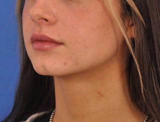Chin Filler Before & After Gallery - Patient 525334 - Image 14