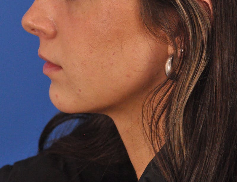 Lip Filler Before & After Gallery - Patient 829046 - Image 17