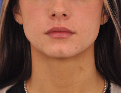 Lip Filler Before & After Gallery - Patient 829046 - Image 2
