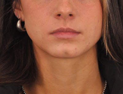 Lip Filler Before & After Gallery - Patient 829046 - Image 1