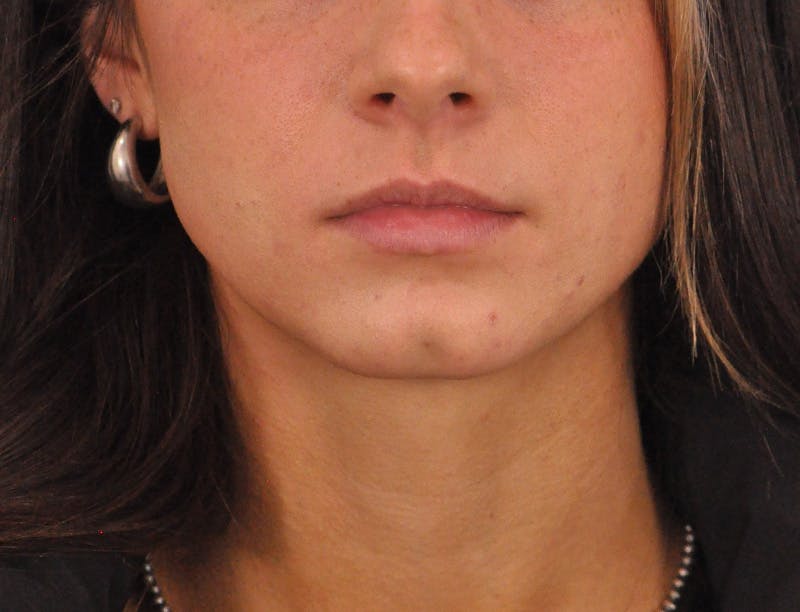 Lip Filler Before & After Gallery - Patient 829046 - Image 1