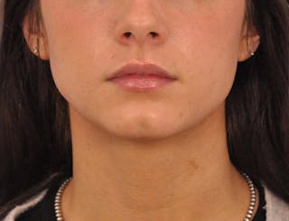 Chin Filler Before & After Gallery - Patient 525334 - Image 8