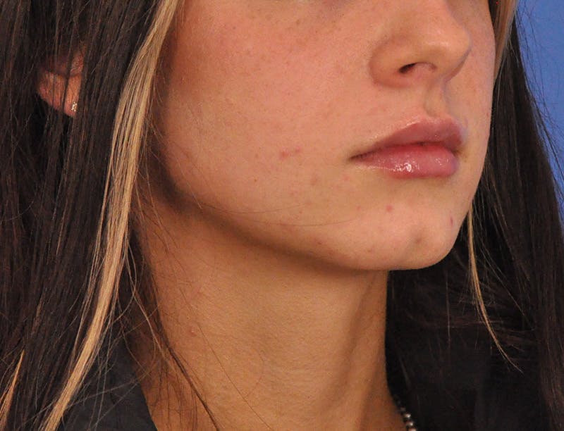 Lip Filler Before & After Gallery - Patient 829046 - Image 5