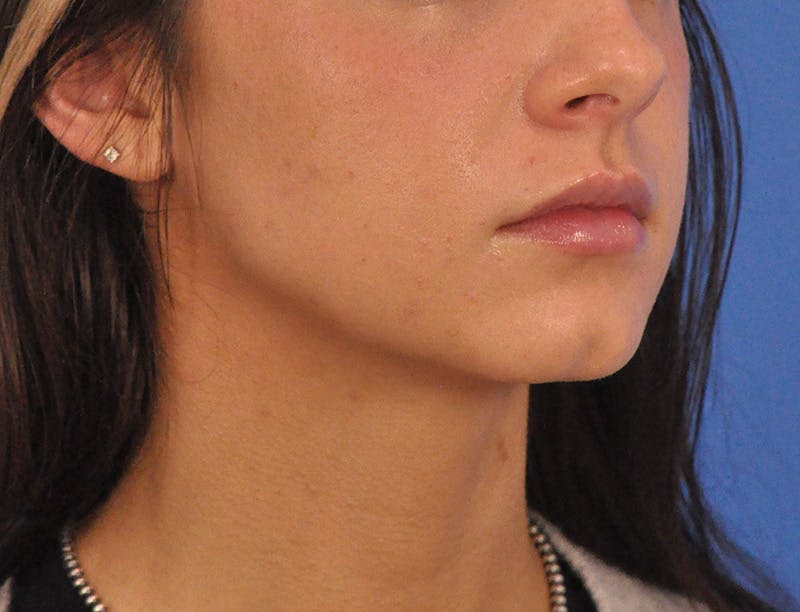 Lip Filler Before & After Gallery - Patient 829046 - Image 6