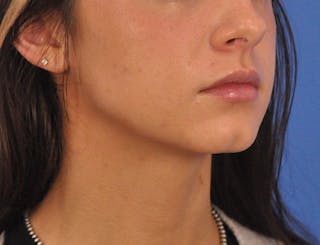 Chin Filler Before & After Gallery - Patient 525334 - Image 10
