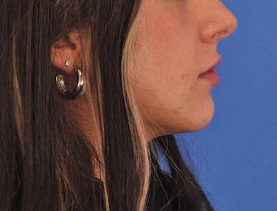 Chin Filler Before & After Gallery - Patient 525334 - Image 1