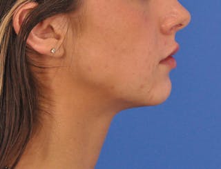 Chin Filler Before & After Gallery - Patient 525334 - Image 2