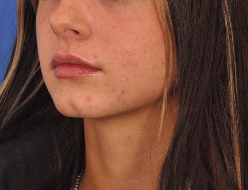 Lip Filler Before & After Gallery - Patient 829046 - Image 13