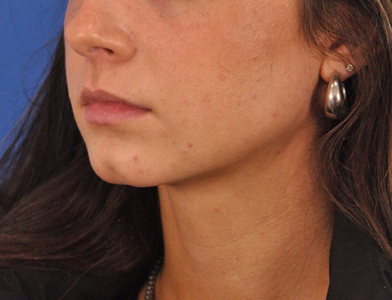 Lip Filler Before & After Gallery - Patient 829046 - Image 15