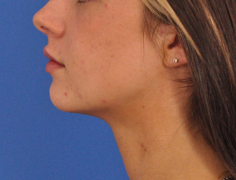 Lip Filler Before & After Gallery - Patient 829046 - Image 18