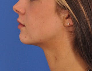 Chin Filler Before & After Gallery - Patient 525334 - Image 18