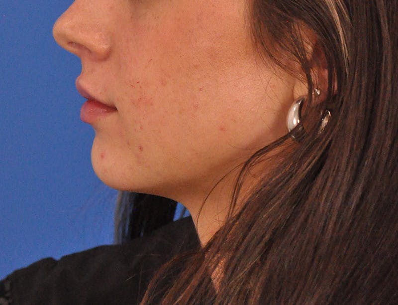 Lip Filler Before & After Gallery - Patient 829046 - Image 19