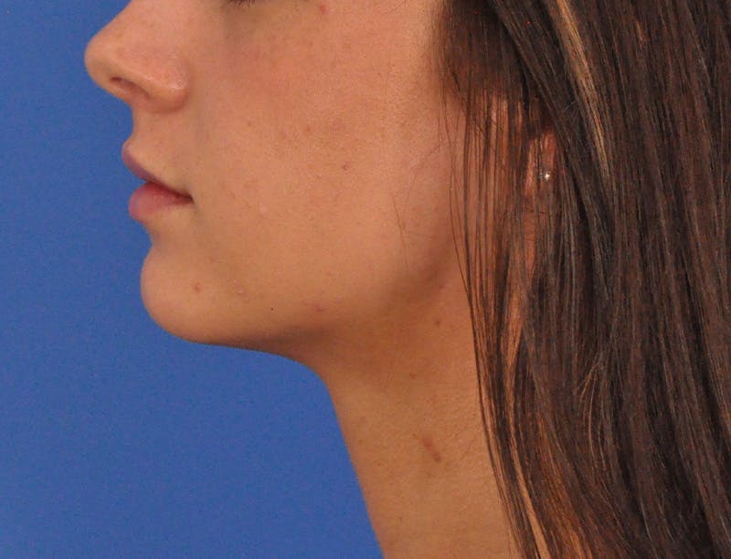 Lip Filler Before & After Gallery - Patient 829046 - Image 20
