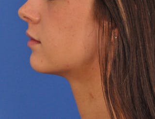 Chin Filler Before & After Gallery - Patient 525334 - Image 20
