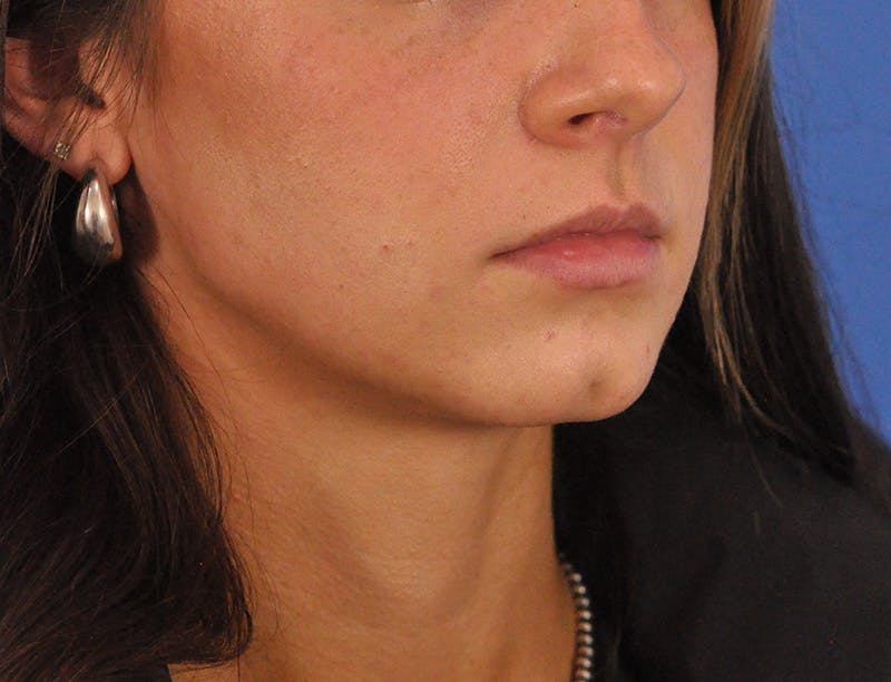 Lip Filler Before & After Gallery - Patient 829046 - Image 7