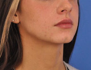 Chin Filler Before & After Gallery - Patient 525334 - Image 12