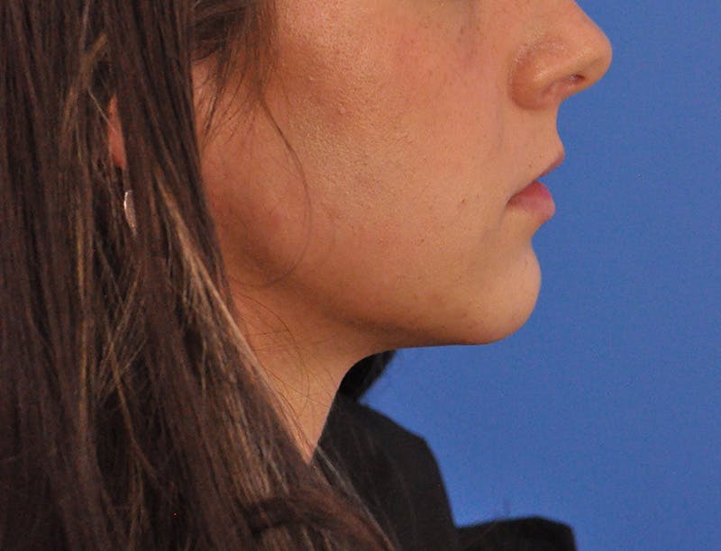 Lip Filler Before & After Gallery - Patient 829046 - Image 11