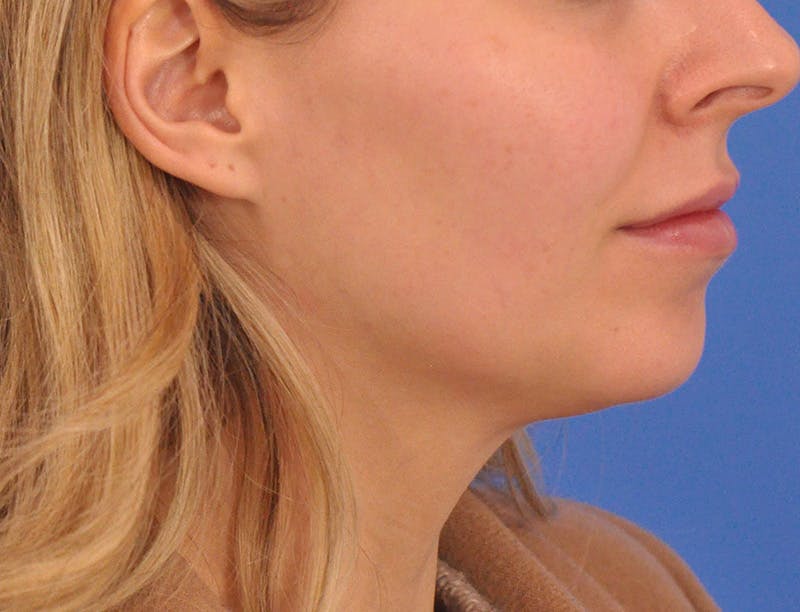 Chin Filler Before & After Gallery - Patient 399856 - Image 11