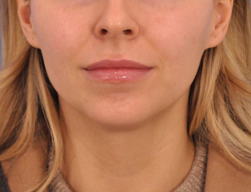 Chin Filler Before & After Gallery - Patient 399856 - Image 7