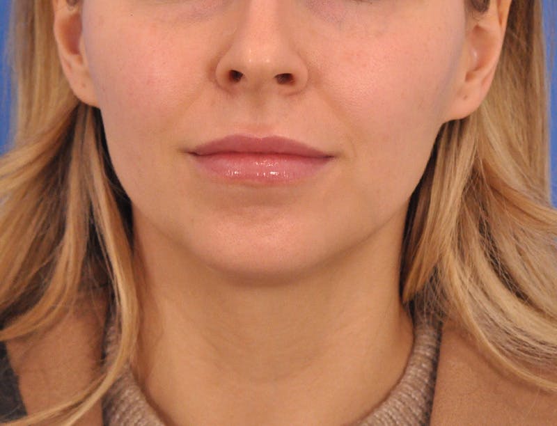 Chin Filler Before & After Gallery - Patient 399856 - Image 5