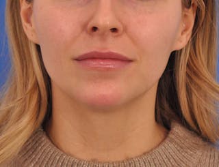 Chin Filler Before & After Gallery - Patient 399856 - Image 6