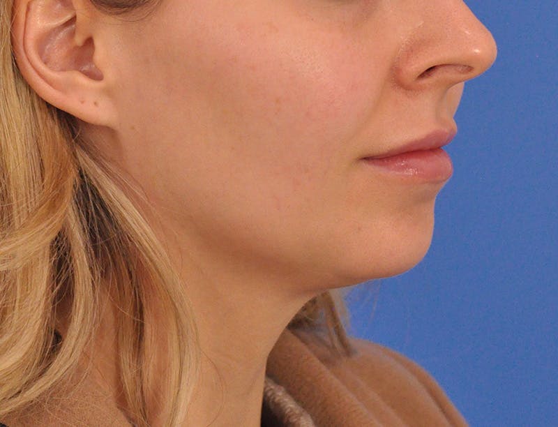 Chin Filler Before & After Gallery - Patient 399856 - Image 9