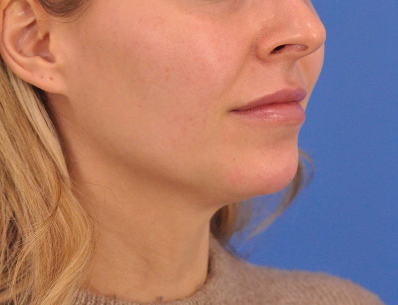 Chin Filler Before & After Gallery - Patient 399856 - Image 10