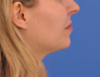 Chin Filler Before & After Gallery - Patient 399856 - Image 4