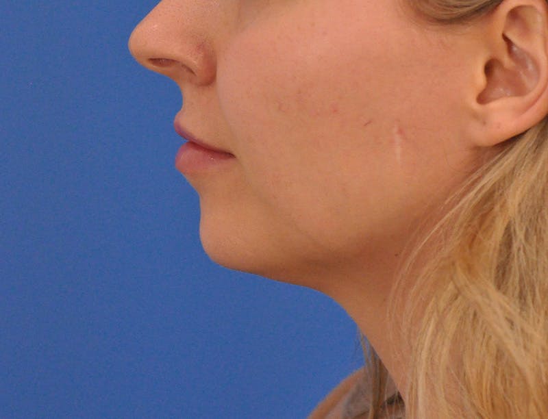 Chin Filler Before & After Gallery - Patient 399856 - Image 13
