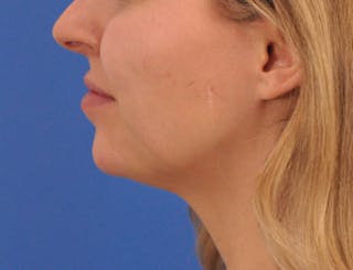 Chin Filler Before & After Gallery - Patient 399856 - Image 14