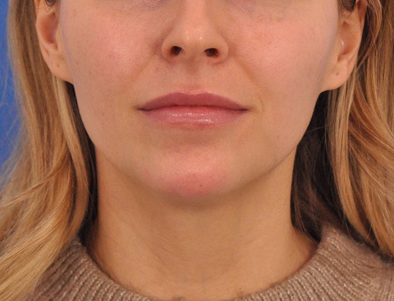 Chin Filler Before & After Gallery - Patient 399856 - Image 8