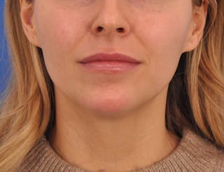 Chin Filler Before & After Gallery - Patient 399856 - Image 8