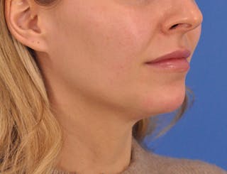 Chin Filler Before & After Gallery - Patient 399856 - Image 12
