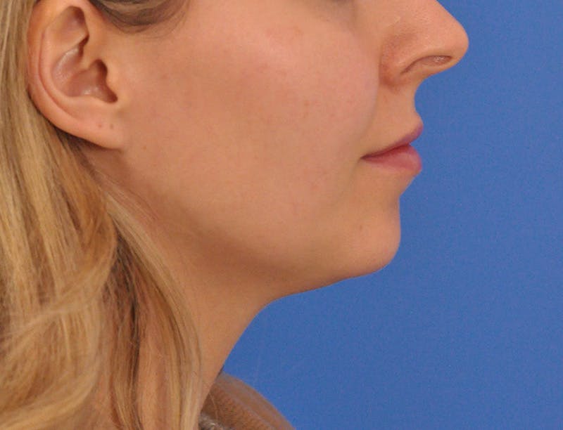 Chin Filler Before & After Gallery - Patient 399856 - Image 3