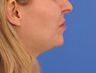 Chin Filler Before & After Gallery - Patient 399856 - Image 2