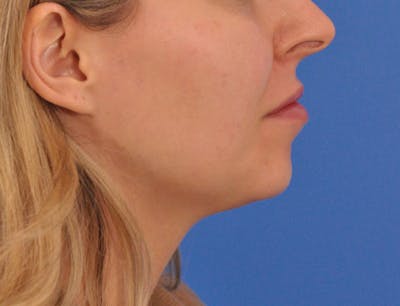 Chin Filler Before & After Gallery - Patient 399856 - Image 1