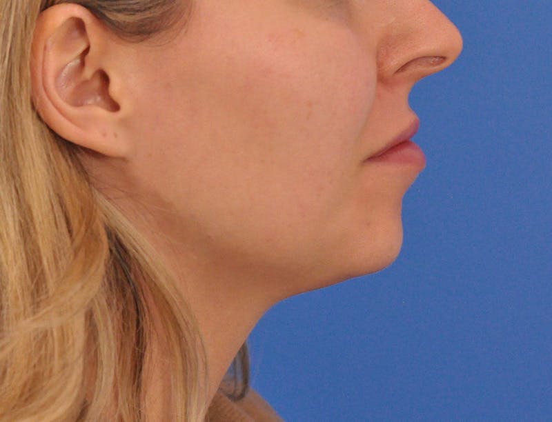Chin Filler Before & After Gallery - Patient 399856 - Image 1