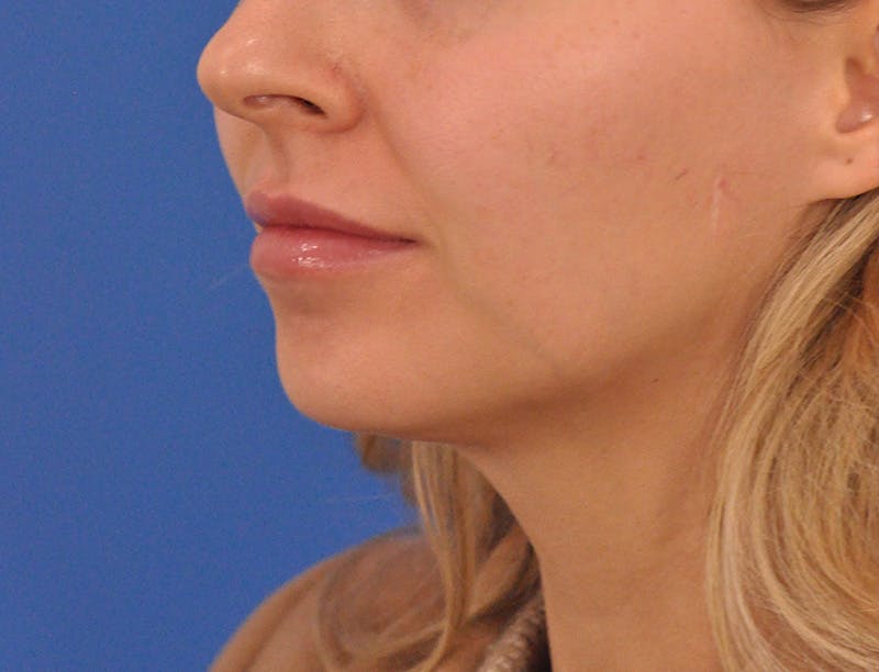 Chin Filler Before & After Gallery - Patient 399856 - Image 17
