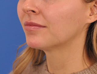 Chin Filler Before & After Gallery - Patient 399856 - Image 18