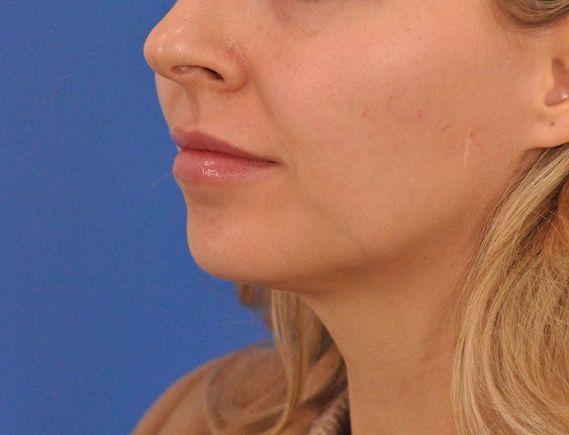 Chin Filler Before & After Gallery - Patient 399856 - Image 15
