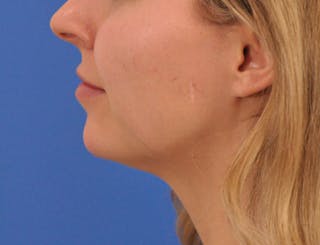 Chin Filler Before & After Gallery - Patient 399856 - Image 20